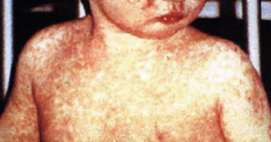 Casos de sarampo aumentam na Flórida com chegada do verão